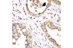 Immunohistochemistry of paraffin-embedded human liver cancer using HADHA antibody. (HADHA antibody  (AA 484-763))