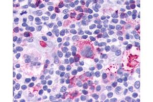 Anti-Leukotriene B4 Receptor / BLT1 antibody IHC of human Lymph Node, Hodgkins Lymphoma. (Leukotriene B4 Receptor/BLT antibody  (C-Term))