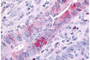 Anti-MAP3K9 antibody  ABIN1049037 IHC staining of human colon cancer.