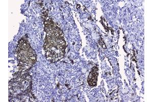 IHC analysis of Cytokeratin 19 using anti-Cytokeratin 19 antibody (ABIN3043288). (Cytokeratin 19 antibody  (C-Term))