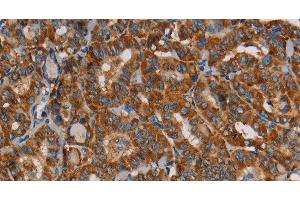 Immunohistochemistry of paraffin-embedded Human thyroid cancer using MRPL39 Polyclonal Antibody at dilution of 1:45 (MRPL39 antibody)