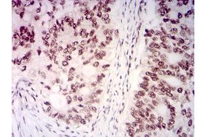 Immunohistochemistry (IHC) image for anti-Lysine (K)-Specific Methyltransferase 2B (KMT2B) (AA 445-599) antibody (ABIN7193438)