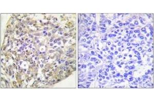 Immunohistochemistry analysis of paraffin-embedded human breast carcinoma, using HSP90B (Phospho-Ser254) Antibody. (HSP90AB1 antibody  (pSer254))