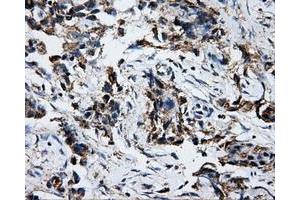 Immunohistochemical staining of paraffin-embedded liver tissue using anti-ATP5Bmouse monoclonal antibody. (ATP5B antibody)