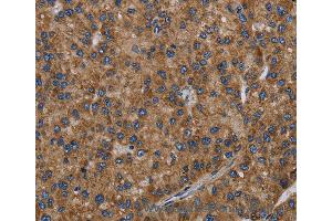 Immunohistochemistry of Human liver cancer using PVRL2 Polyclonal Antibody at dilution of 1:40 (PVRL2 antibody)