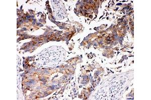 IHC-P: MCT5 antibody testing of human breast cancer tissue (SLC16A4 antibody  (N-Term))