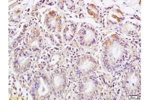 Formalin-fixed and paraffin embedded human colon carcinoma labeled with Anti DEPTOR/DEPDC6 Polyclonal Antibody, Unconjugated (ABIN1387597) at 1:200 followed by conjugation to the secondary antibody and DAB staining (DEPTOR antibody  (AA 56-170))