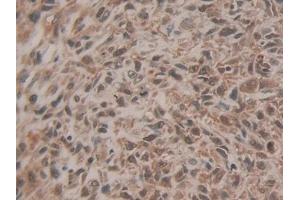 Detection of EZH2 in Human Lung cancer Tissue using Polyclonal Antibody to Enhancer Of Zeste Homolog 2 (EZH2) (EZH2 antibody  (AA 51-285))