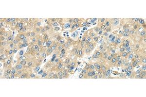 Immunohistochemistry of paraffin-embedded Human liver cancer tissue using VPS4A Polyclonal Antibody at dilution 1:40 (VPS4A antibody)