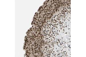 Immunohistochemical staining (Formalin-fixed paraffin-embedded sections) of human urinary bladder with DAXX polyclonal antibody  shows strong nuclear and cytoplasmic positivity in urothelial cells. (DAXX antibody  (AA 481-626))