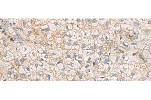Immunohistochemistry of paraffin-embedded Human liver cancer tissue using SLC30A6 Polyclonal Antibody at dilution of 1:70(x200) (SLC30A6 antibody)