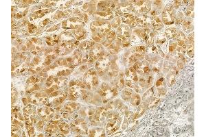 ABIN6258842 and ABIN6274149 at 1/100 staining human renal cell carcinoma by IHC-P.