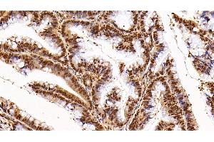 Detection of GAPDH in Human Colorectal cancer Tissue using Anti-Glyceraldehyde-3-Phosphate Dehydrogenase (GAPDH) Monoclonal Antibody (GAPDH antibody  (AA 2-148))