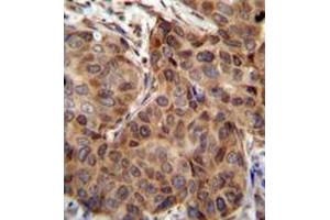 mmunohistochemistry analysis in human breast carcinoma (formalin-fixed, paraffin-embedded) using Sorting nexin-24 (SNX24)  Antibody (N-term), followed by peroxidase conjugation of the secondary antibody and DAB staining. (SNX24 antibody  (N-Term))