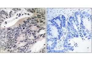Immunohistochemistry analysis of paraffin-embedded human colon carcinoma tissue, using ACSS1 Antibody. (ACSS1 antibody)