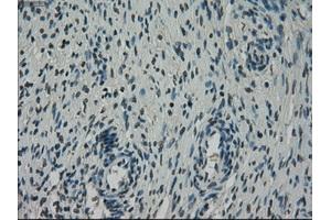 Immunohistochemical staining of paraffin-embedded Adenocarcinoma of breast tissue using anti-NEK6 mouse monoclonal antibody. (NEK6 antibody)