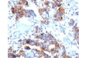 IHC testing of human gastric carcinoma stained with MUC5AC antibody (45M1).