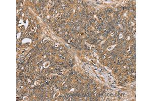 Immunohistochemistry of Human ovarian cancer using PTPN20B Polyclonal Antibody at dilution of 1:30