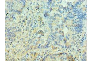 Immunohistochemistry of paraffin-embedded human lung cancer using ABIN7150969 at dilution of 1:100 (PIAS3 antibody  (AA 399-628))