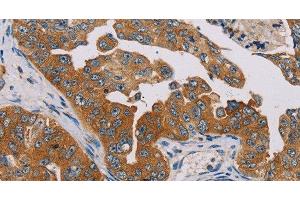 Immunohistochemistry of paraffin-embedded Human cervical cancer tissue using MBNL3 Polyclonal Antibody at dilution 1:30 (MBNL3 antibody)
