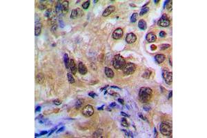 Immunohistochemical analysis of POTEA staining in human breast cancer formalin fixed paraffin embedded tissue section. (POTEA antibody  (C-Term))