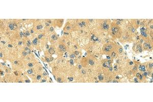 Immunohistochemistry of paraffin-embedded Human liver cancer using TRIM10 Polyclonal Antibody at dilution of 1/35 (TRIM10 antibody)