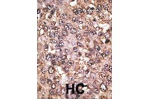 Formalin-fixed and paraffin-embedded human cancer tissue reacted with the primary antibody, which was peroxidase-conjugated to the secondary antibody, followed by DAB staining. (SIRT5 antibody  (C-Term))