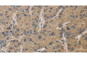 Immunohistochemistry of paraffin-embedded Human liver cancer tissue using TBXAS1 Polyclonal Antibody at dilution 1:30 (TBXAS1 antibody)