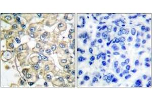 Immunohistochemistry analysis of paraffin-embedded human breast carcinoma tissue, using FGFR1 Oncogene Partner Antibody.