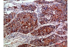 Immunohistochemical analysis of paraffin-embedded human-lung-cancer, antibody was diluted at 1:200 (MLL/KMT2A antibody  (AA 3850-3900))