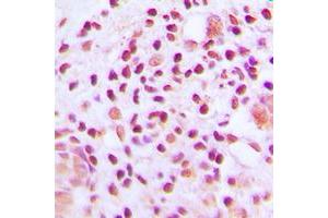 Immunohistochemical analysis of MUTYH staining in human lung cancer formalin fixed paraffin embedded tissue section. (MUTYH antibody  (Center))