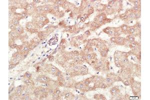 Paraformaldehyde-fixed, paraffin embedded human liver carcinoma tissue, Antigen retrieval by boiling in sodium citrate buffer(pH6) for 15min, Block endogenous peroxidase by 3% hydrogen peroxide for 30 minutes, Blocking buffer (normal goat serum) at 37°C for 20min, Antibody incubation with Rabbit Anti-ALDH1 Polyclonal Antibody, Unconjugated  at 1:400 overnight at 4°C, followed by a conjugated secondary and DAB staining (ALDH1A1 antibody  (AA 201-300))