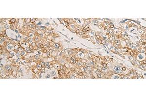 Immunohistochemistry of paraffin-embedded Human prost at e cancer tissue using HLA-DMB Polyclonal Antibody at dilution of 1:40(x200) (HLA-DMB antibody)