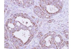 IHC-P Image Immunohistochemical analysis of paraffin-embedded NCIN87 xenograft, using fumarate hydratase , antibody at 1:500 dilution. (FH antibody)