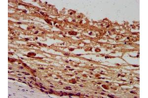IHC image of ABIN7162587 diluted at 1:400 and staining in paraffin-embedded human melanoma performed on a Leica BondTM system. (Pannexin 2 antibody  (AA 370-470))