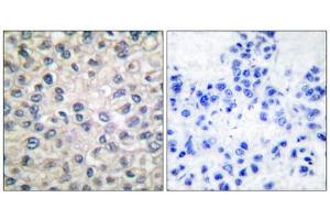 Immunohistochemical analysis of paraffin-embedded human breast carcinoma tissue, using Catenin- alpha antibody. (CTNNA1 antibody  (C-Term))