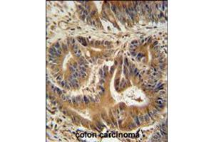 VPS52 antibody immunohistochemistry analysis in formalin fixed and paraffin embedded human colon carcinoma followed by peroxidase conjugation of the secondary antibody and DAB staining. (VPS52 antibody  (C-Term))