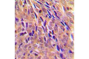 Immunohistochemical analysis of IKK alpha (pT23) staining in human breast cancer formalin fixed paraffin embedded tissue section. (IKK alpha antibody  (N-Term, pSer23))