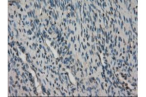 Immunohistochemical staining of paraffin-embedded Adenocarcinoma of breast tissue using anti-STK39 mouse monoclonal antibody. (STK39 antibody)