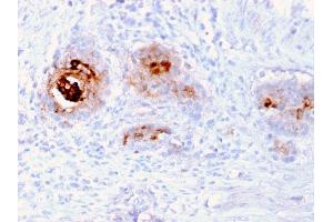 Formalin-fixed, paraffin-embedded human Breast Carcinoma stained with TAG-72 Recombinant Mouse Monoclonal Antibody (rB72. (Recombinant TAG-72 / CA72.4 antibody)