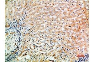 Immunohistochemical analysis of paraffin-embedded human-liver-cancer, antibody was diluted at 1:200 (WISP3 antibody  (AA 1-50))