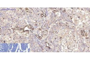 Immunohistochemistry of paraffin-embedded Human lung cancer tissue using CD45 Monoclonal Antibody at dilution of 1:200. (CD45 antibody)