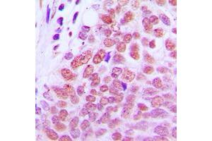 Immunohistochemical analysis of RXR gamma staining in human breast cancer formalin fixed paraffin embedded tissue section. (Retinoid X Receptor gamma antibody  (Center))