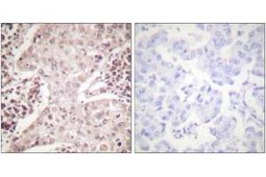 Immunohistochemistry analysis of paraffin-embedded human breast carcinoma, using Chk2 (Ab-387) Antibody. (CHEK2 antibody  (AA 361-410))