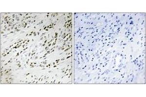 Immunohistochemistry analysis of paraffin-embedded human prostate carcinoma tissue, using TSH2 Antibody.