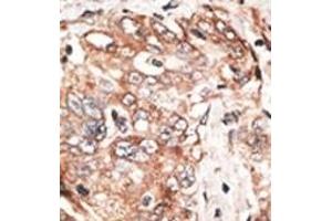 Formalin-fixed and paraffin-embedded human cancer tissue reacted with the primary antibody, which was peroxidase-conjugated to the secondary antibody, followed by DAB staining. (TPX2 antibody  (AA 350-382))