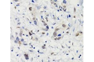 Immunohistochemistry of paraffin-embedded Human gastric cancer using Phospho-Stat3(S727) Polyclonal Antibody at dilution of 1:100 (40x lens).