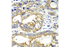 Immunohistochemistry of paraffin-embedded human gastric cancer using AK2 antibody.