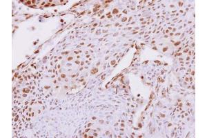 IHC-P Image Carboxypeptidase E antibody [N2C2], Internal detects Carboxypeptidase E protein at nucleus on human breast cancer by immunohistochemical analysis. (CPE antibody)