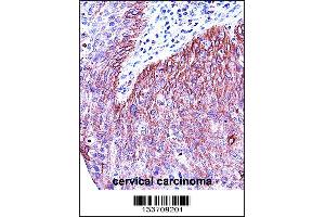 KRT6B Antibody immunohistochemistry analysis in formalin fixed and paraffin embedded human cervical carcinoma followed by peroxidase conjugation of the secondary antibody and DAB staining. (Keratin 6B antibody  (AA 207-236))